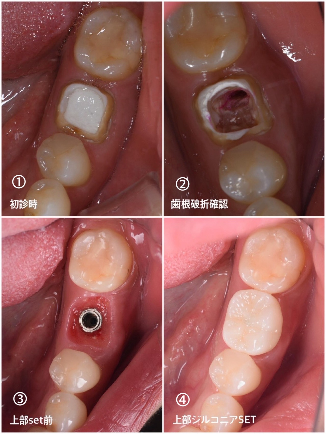 矯正治療　症例