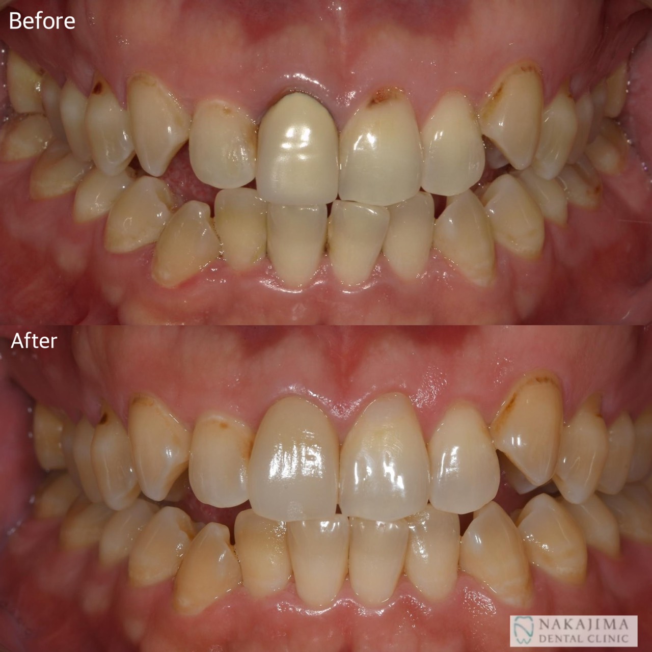 ジルコニアボンド