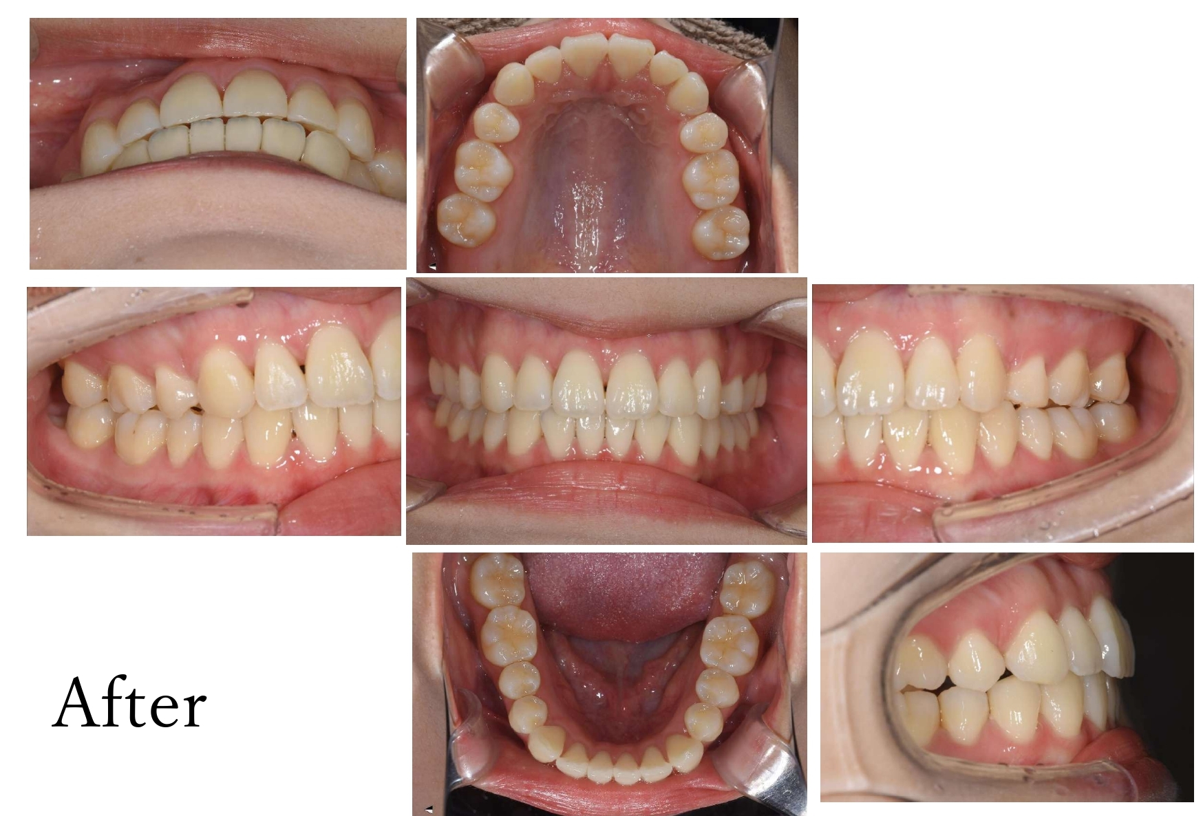矯正治療　After