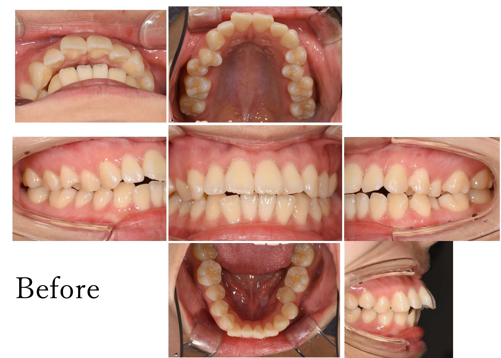 矯正治療　Before