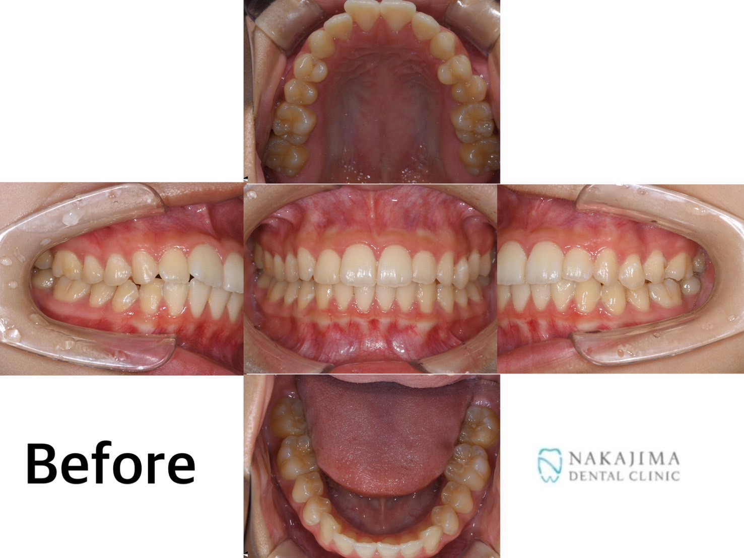 歯列矯正ビフォーアフタオー