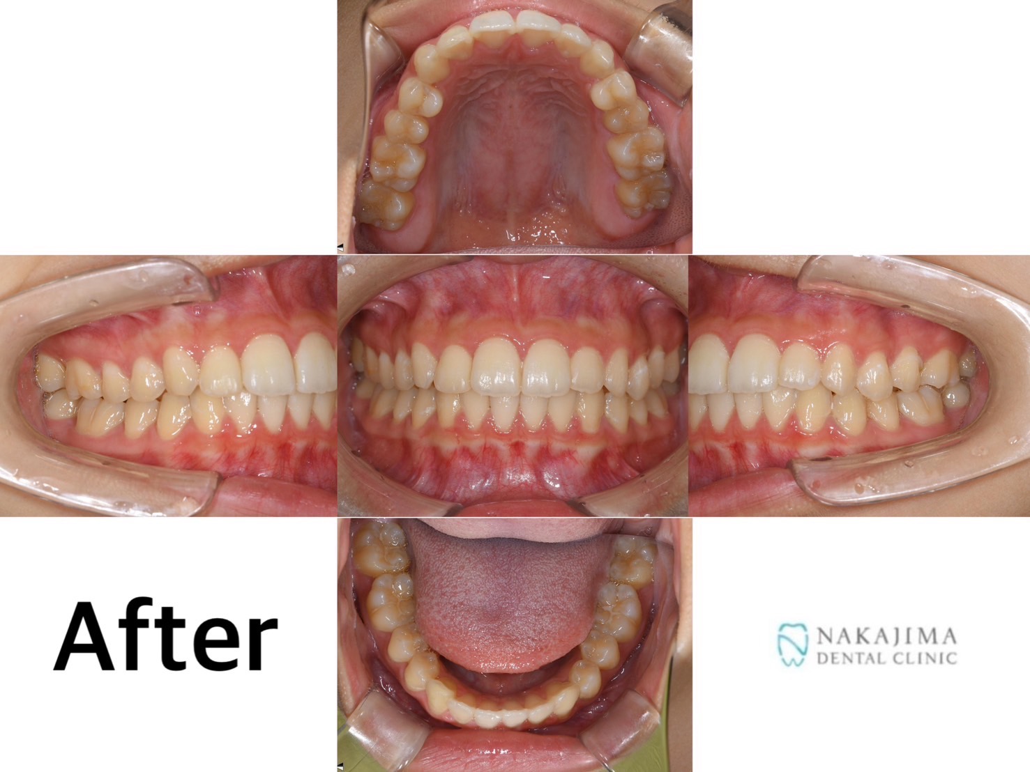 歯列矯正ビフォーアフター